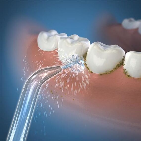 Waterpik Classic Jet Tip Düse für elektrischen Flosser, 3 image